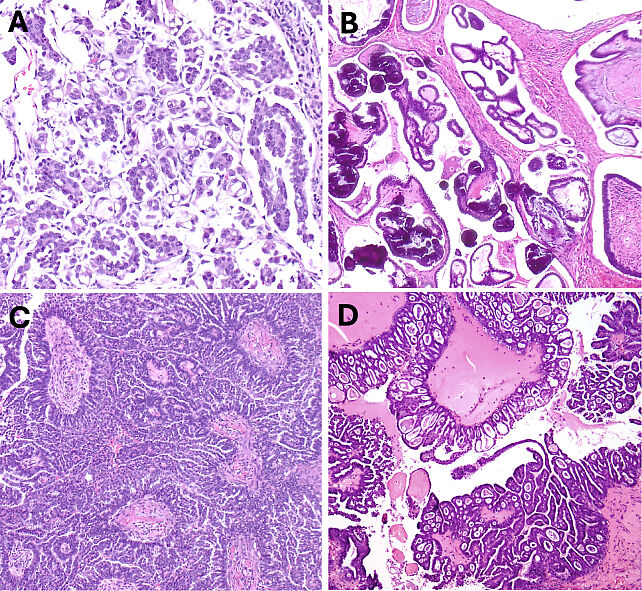Pathology of Ovarian, Fallopian Tube and Primary Peritoneal